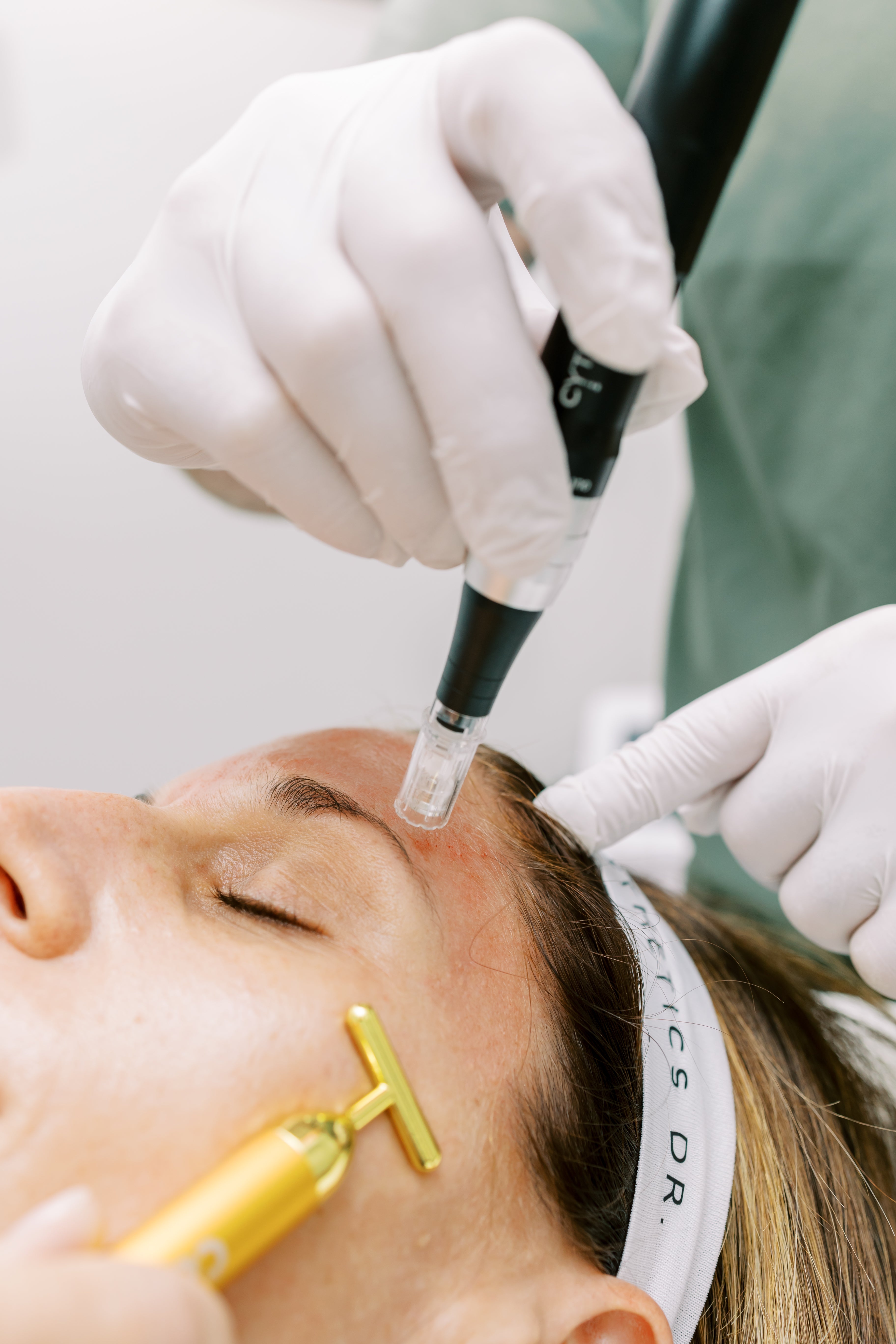 Asheville NC microneedling