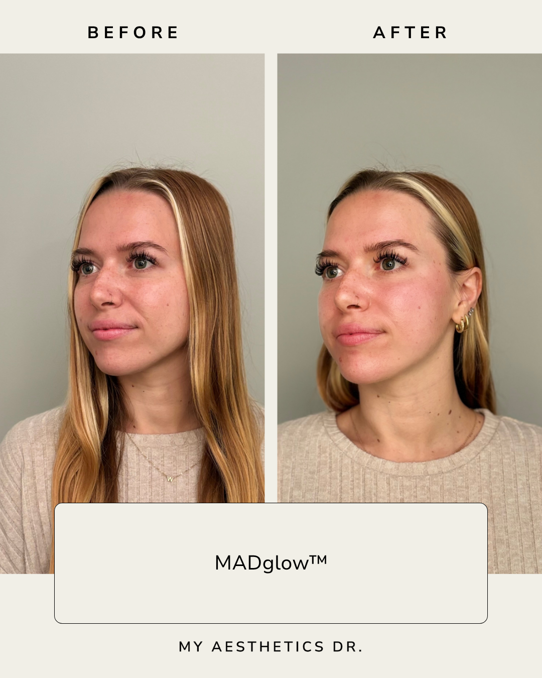 MADglowAshevilleNC_hydradermabrasion.png