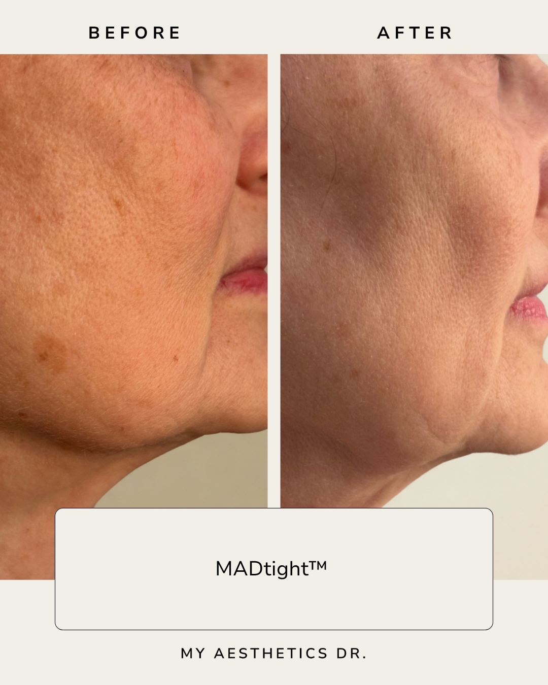 MicroneedlingAshevilleNCBeforeandAfter.png
