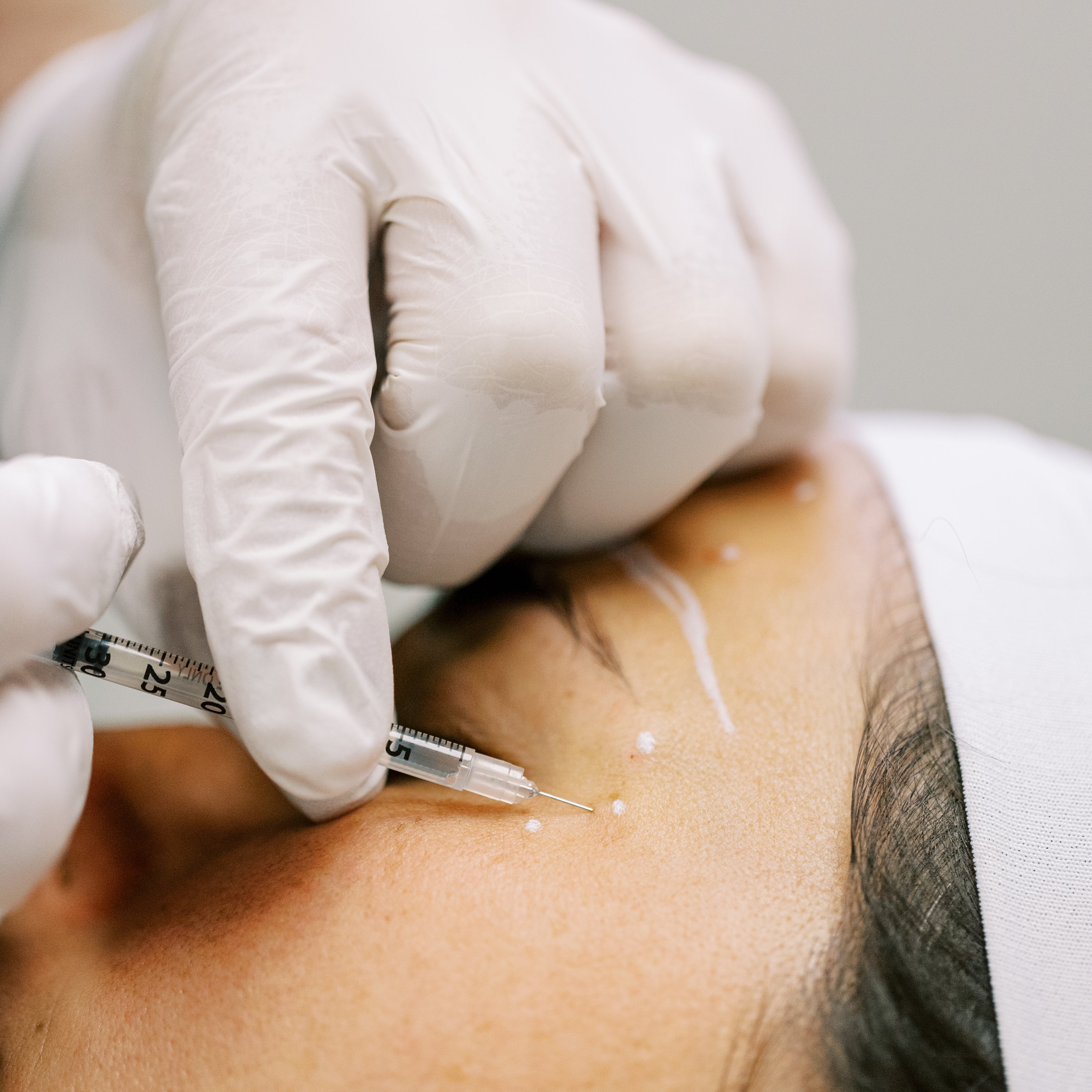 Can I Just Get Tox for My Crow’s Feet? Why a Full Facial Analysis Matters