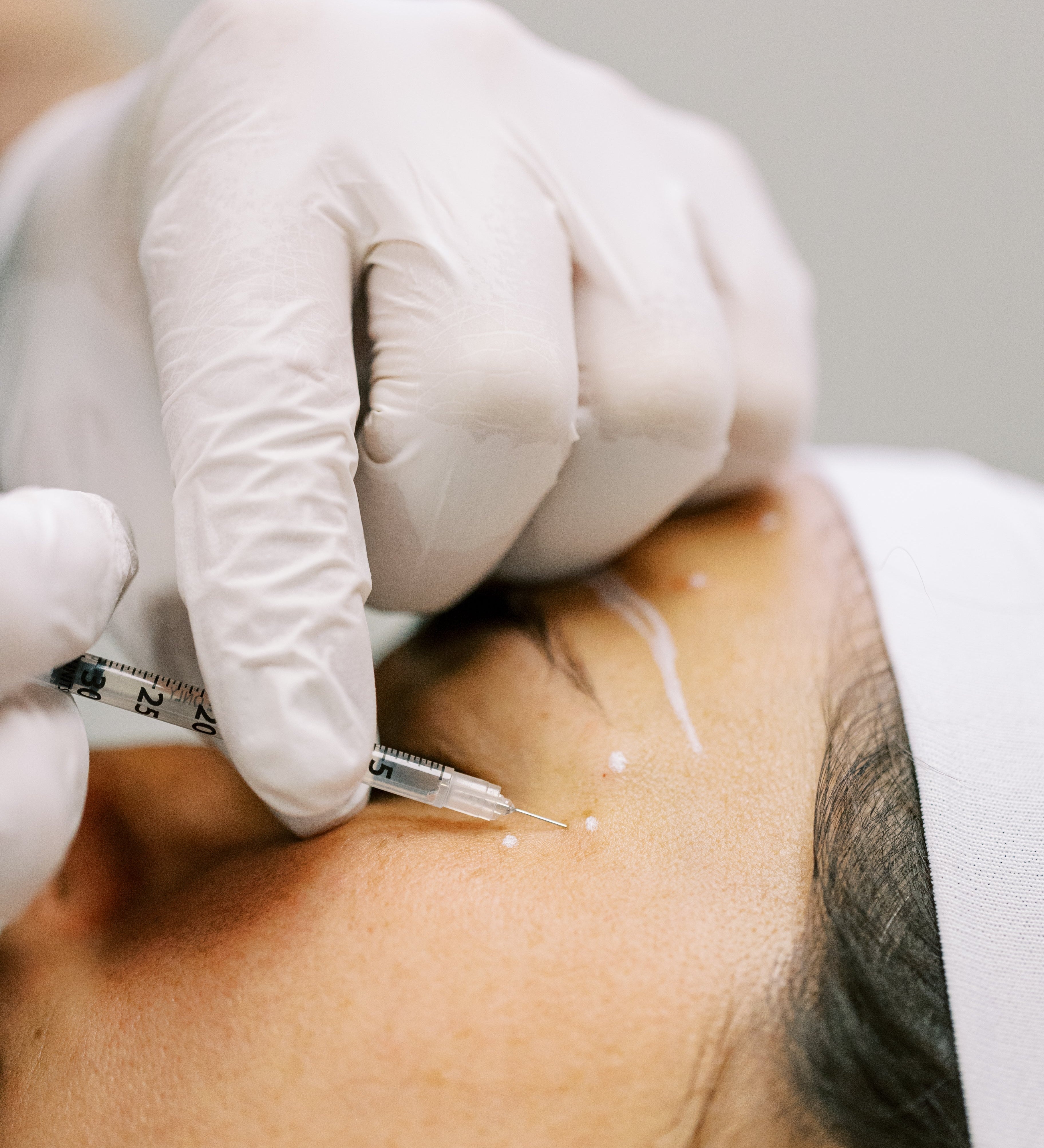 Can I Just Get Tox for My Crow’s Feet? Why a Full Facial Analysis Matters
