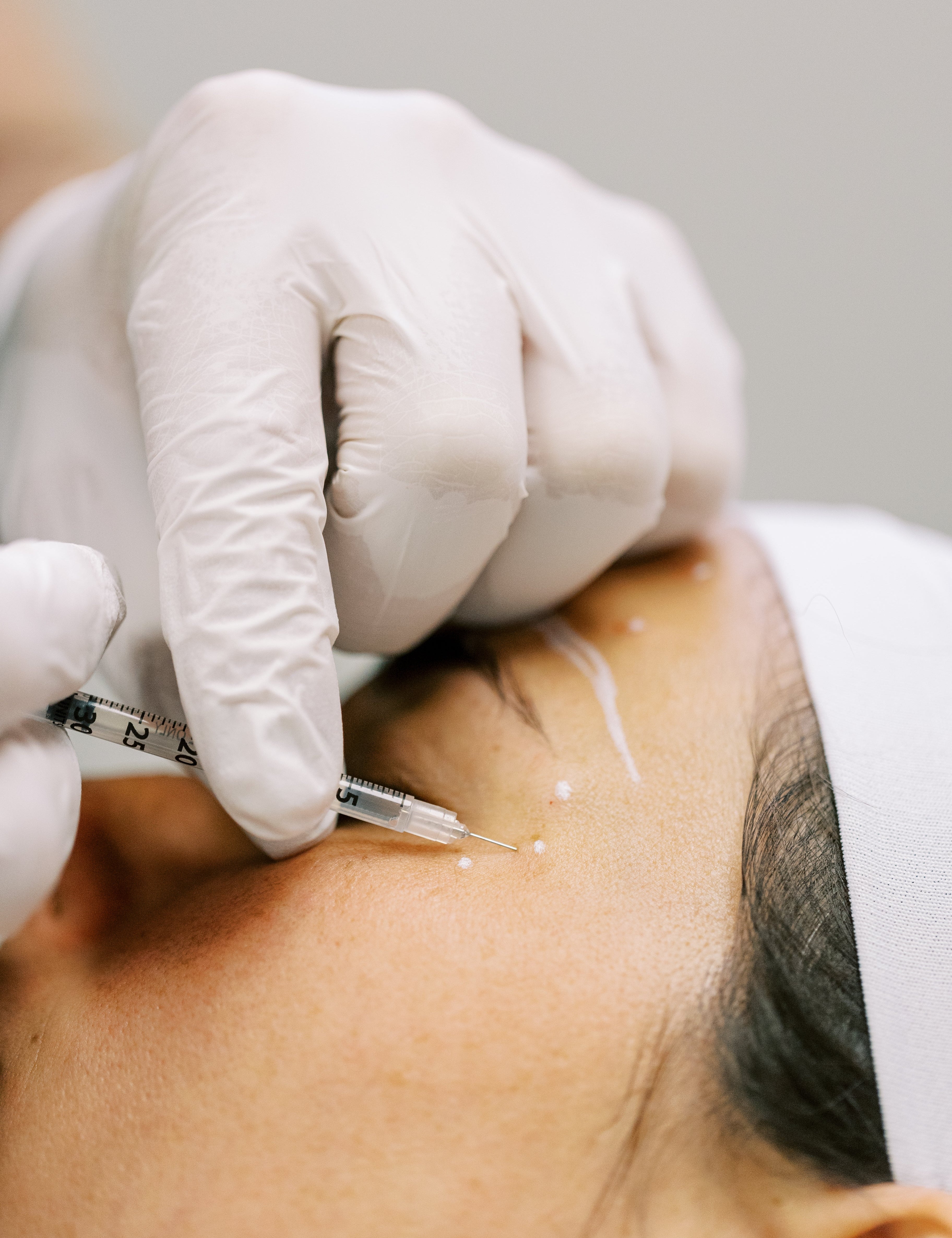 Can I Just Get Tox for My Crow’s Feet? Why a Full Facial Analysis Matters