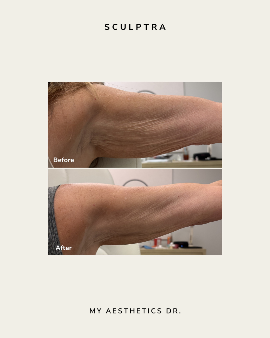 Medspa_asheville_nc_sculptra_arm_skin.png