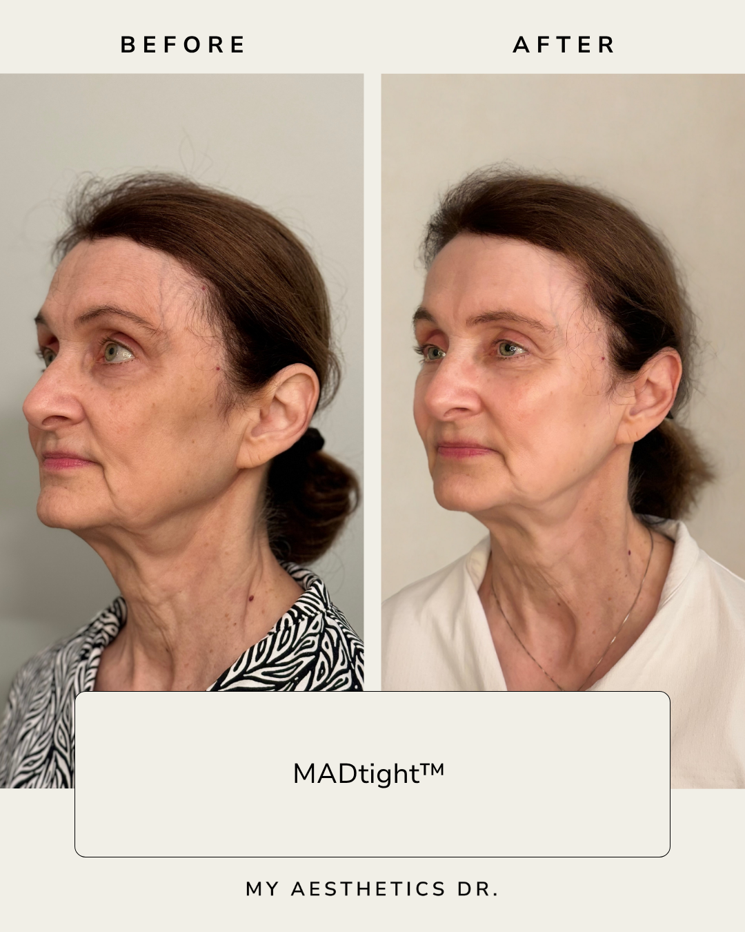 MicroneedlingAshevilleNCGrowthFactors.png