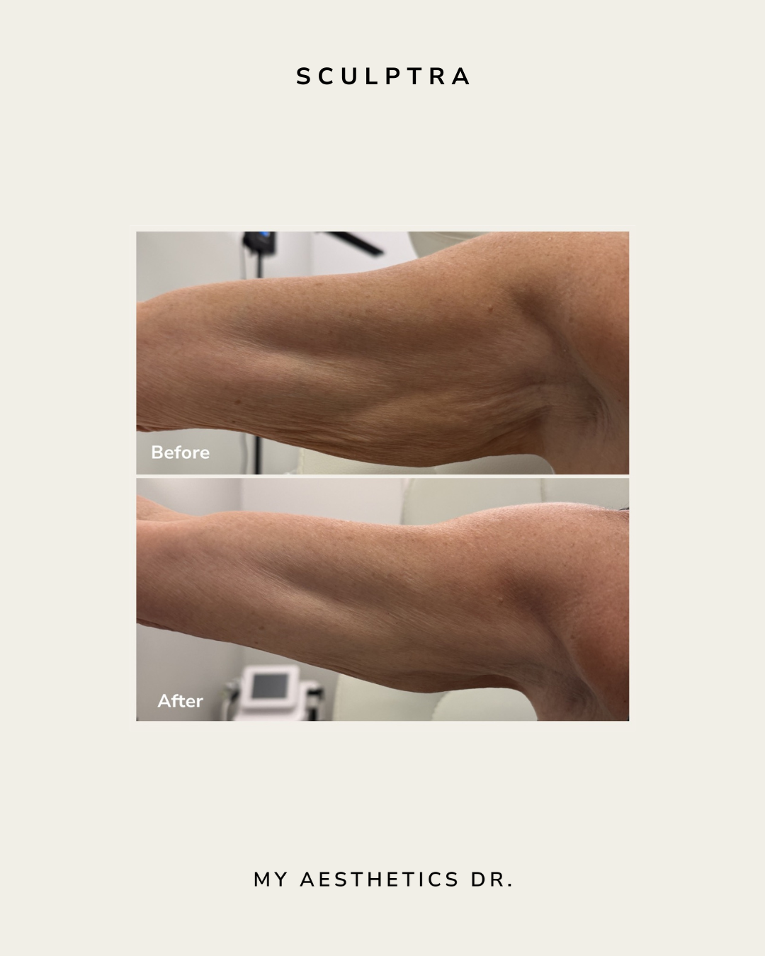 Sculptra.png