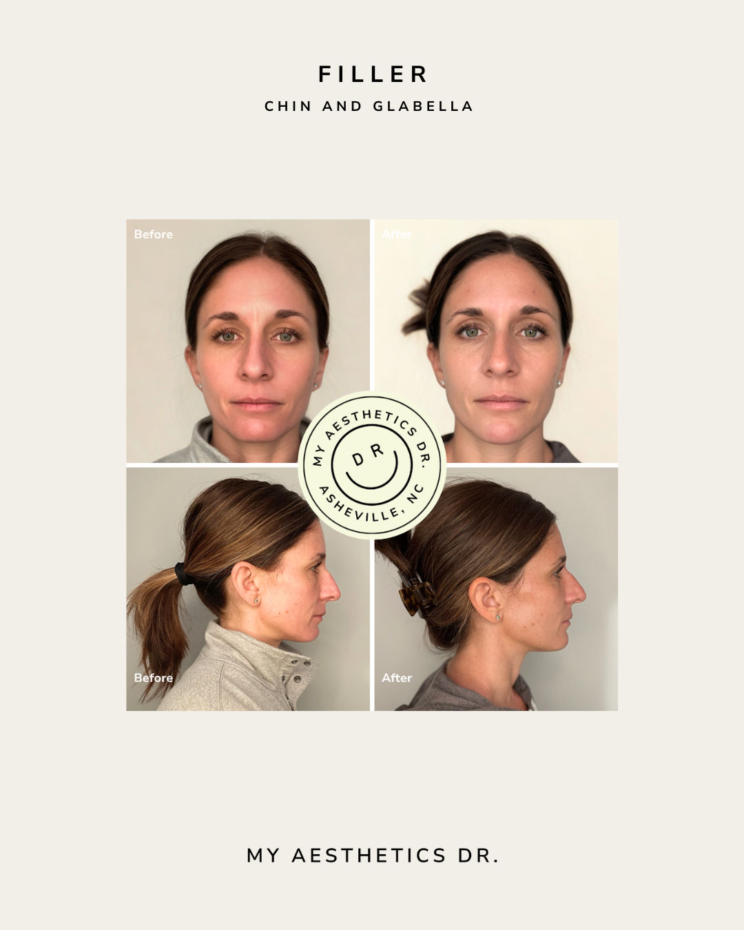 asheville_chin_filler.png