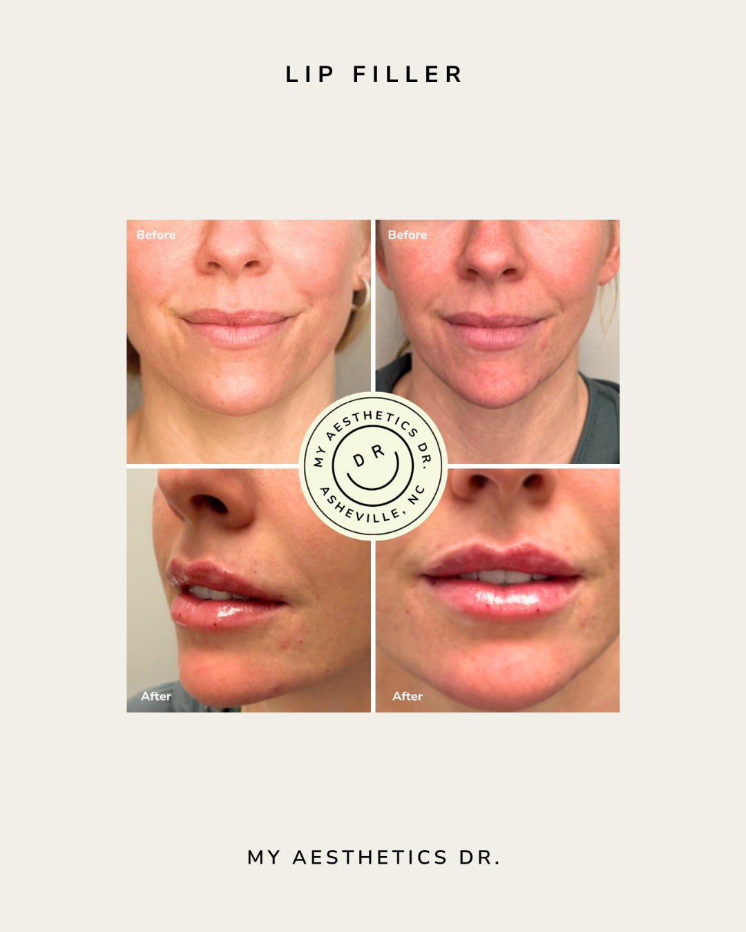 asheville_lip_filler_before_and_after.png