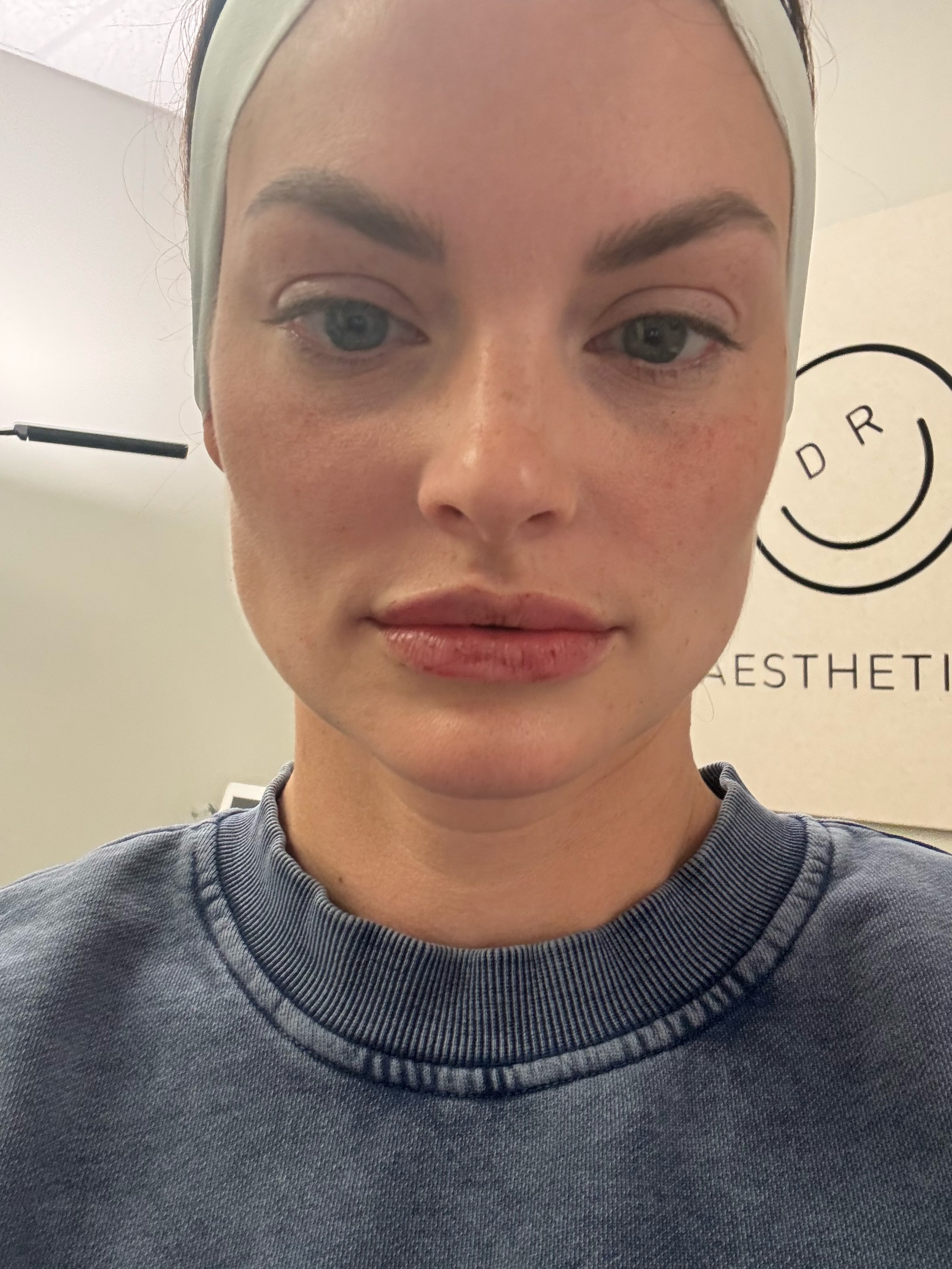 lip_filler_touch_up_mills_river.heic